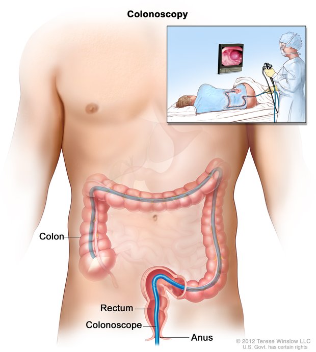  A colonoscope inserted in the anus, rectum, and colon. An inset shows a health care professional performing a colonoscopy and a patient on their side.  