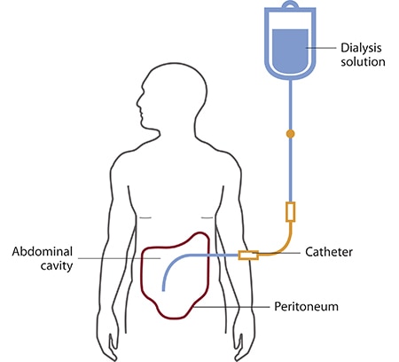 Diagram of peritoneal dialysis shows a bag of dialysis solution connected to a catheter going into the abdominal cavity—also outlines the peritoneum.