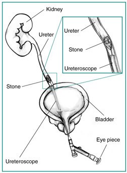 Kidney Stones In Children | NIDDK