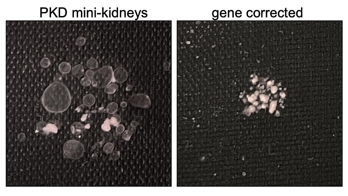 Two photos of tissue chips. The one on the left shows mini kidneys with homozygous polycystic kidney disease mutations. The one on the right shows gene-corrected heterozygotes.