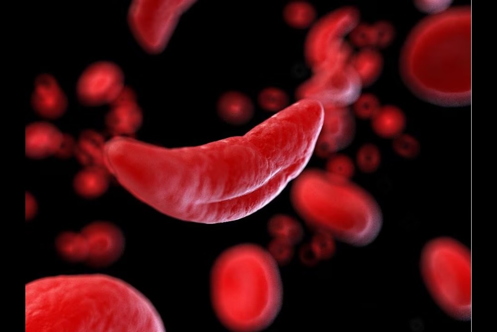 A 3D image of sickle cell anemia