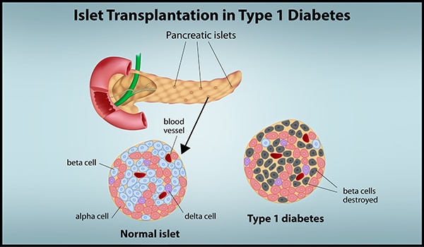 Type 1 Diabetes Diagram Pancreas