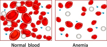 anemia of chronic disease