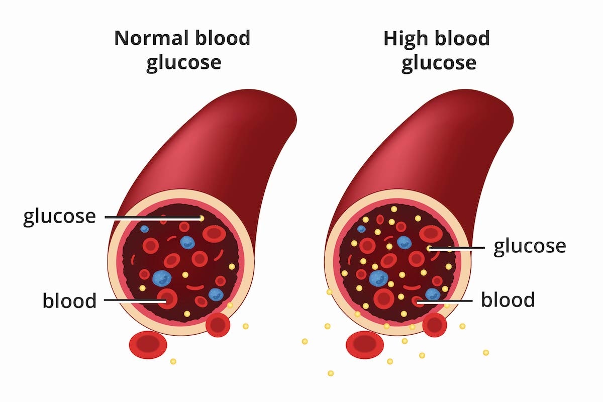 Symptoms of High Blood Sugar (Hyperglycemia)