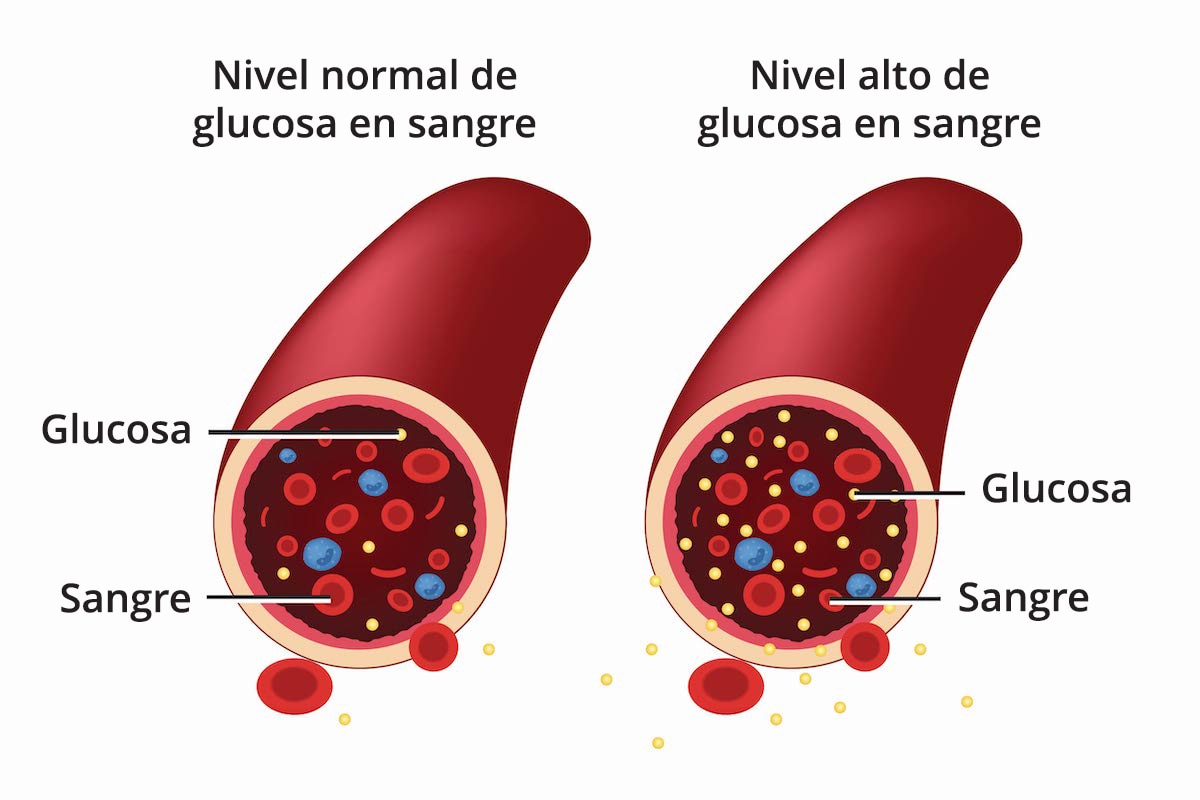 一个伊兹基尔达，un diagrama de un vaso sanguíneo que tiene un vel normal de glucosa en sangre y contiene menos moléculas de glucasa。这是一个很好的例子，这是一个很好的例子，也是一个很好的例子。 