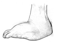 Illustration of Charcot's foot showing an enlarged sole of the foot with a rounded shape.