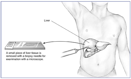 liver biopsy needle
