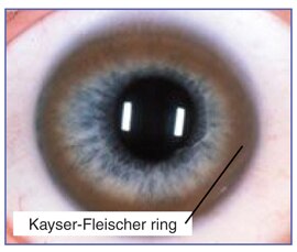 Wilson Disease | NIDDK