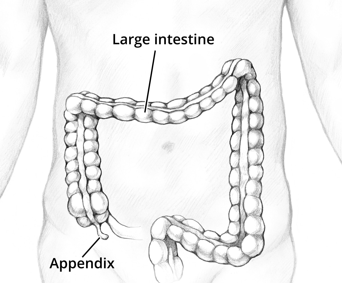 burst appendix symptoms