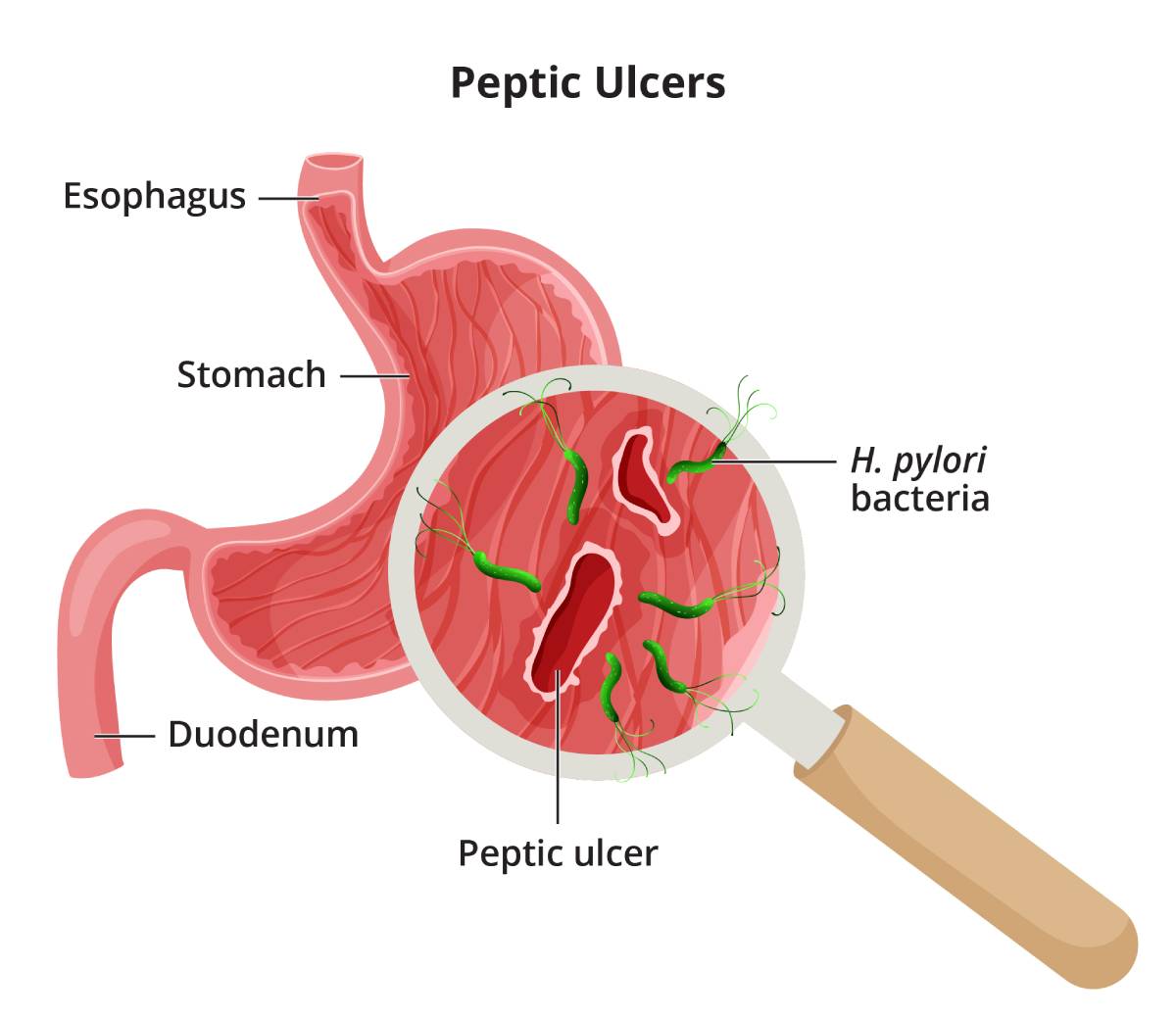 Peptic ulcers often develop due to bacteria infection