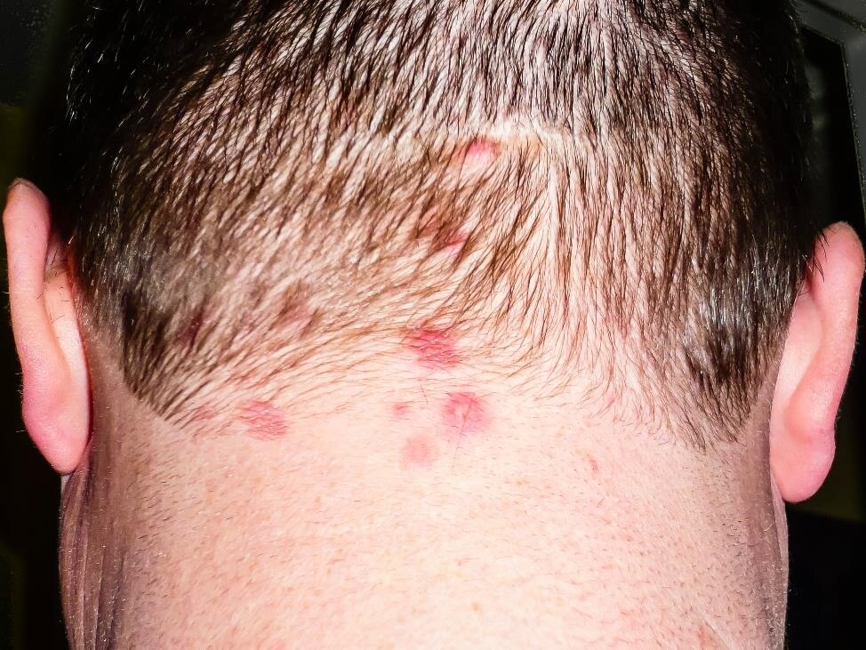 Erupción de dermatitis herpetiforme en la parte posterior del cuero cabelludo de una persona.