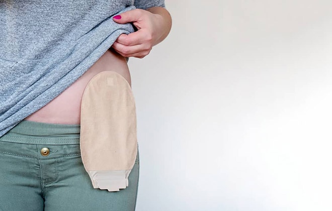how long can you live with a stoma bag