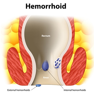 Describes the symptoms, diagnosis, and medical and surgical treatments for hemorrhoids.