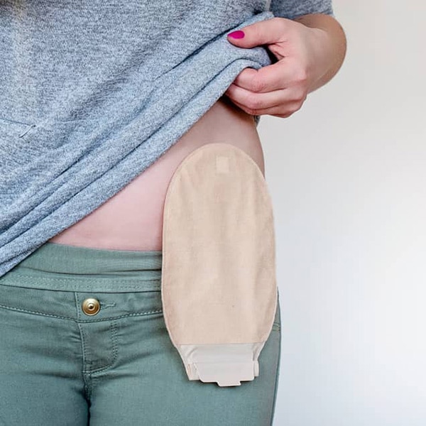 Colostomy bag: Types, uses, and living with one