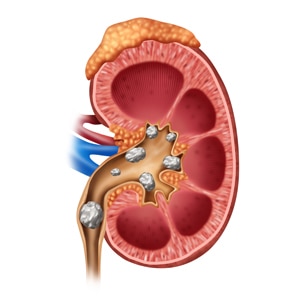 types of kidney stones in men
