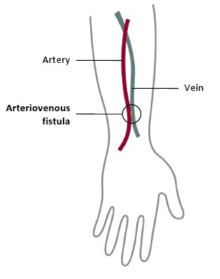 Hemodialysis | NIDDK