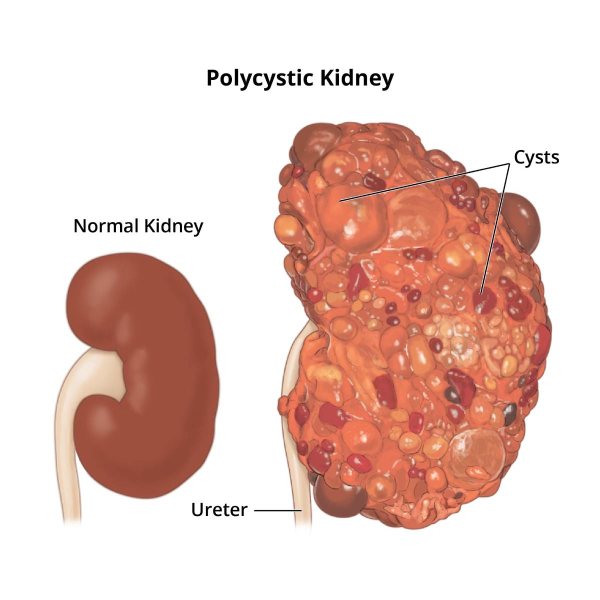 Kidney Disease - Causes, Symptoms, Treatment & Diagnosis