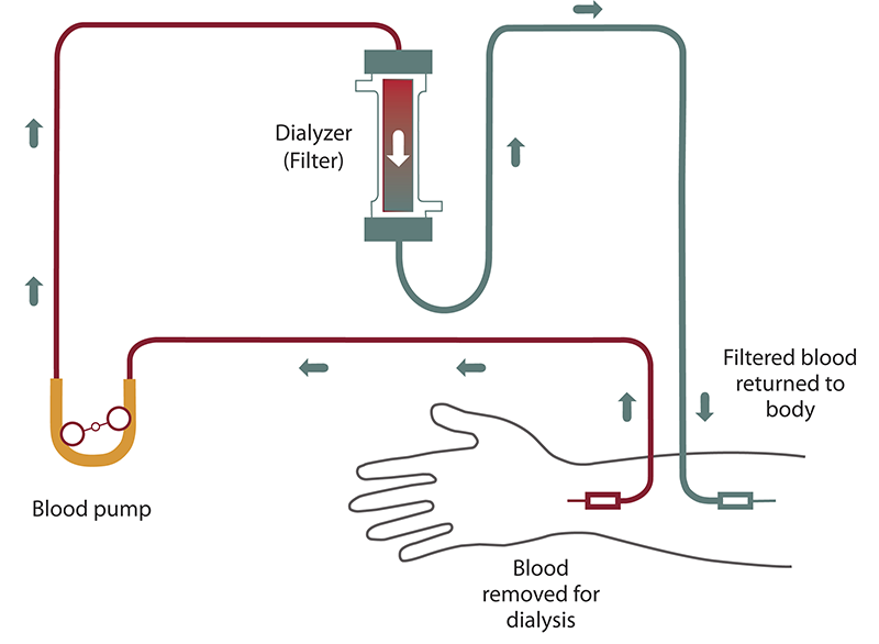 Choosing a Treatment for Kidney Failure | NIDDK