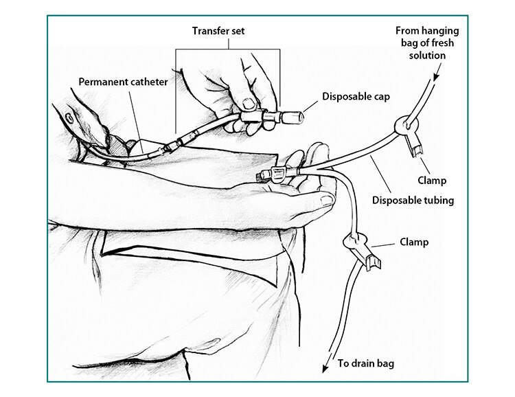 Peritoneal Dialysis Niddk