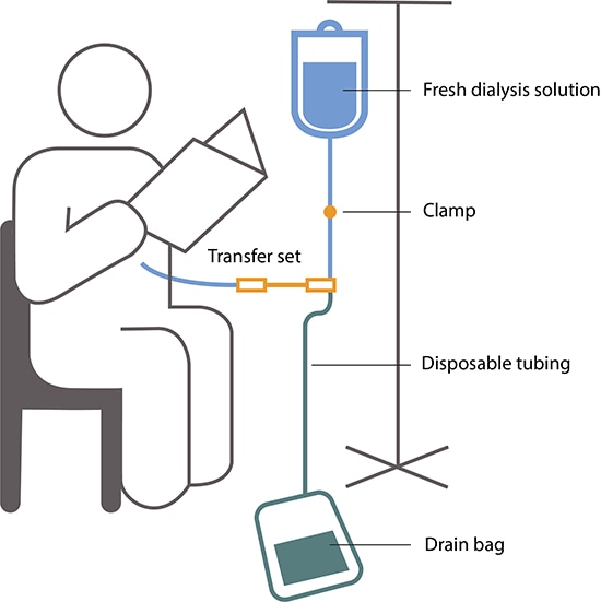 Drawing of a person reading during CAPD. A bag of fresh dialysis solution hangs from a pole and is connected to a tube that has a clamp. The tube connects to a transfer set, a disposable tube that connects to another tube that enters the person's abdomen. Tubing also connects from the transfer set to the drain bag on the floor.