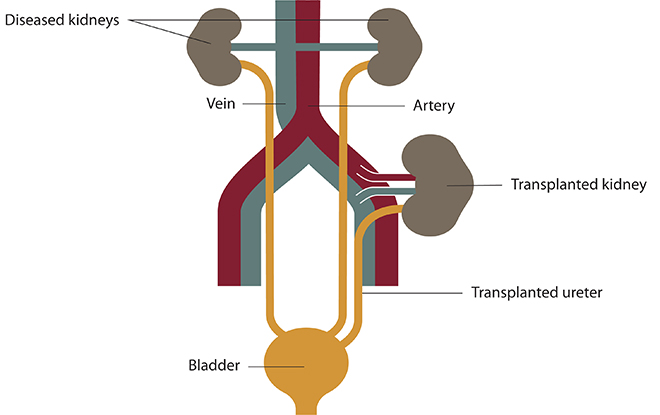 Choosing a Treatment for Kidney Failure | NIDDK