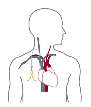 Hemodialysis | NIDDK