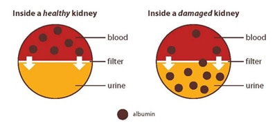 Albuminuria: Albumin in the Urine - NIDDK