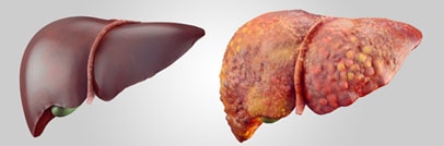 Um fígado saudável à esquerda e um fígado doente à direita.