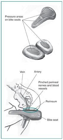 The pressure regions of bicycle seats with and without a nose. A second image shows a cross-section of a person sitting on a bike seat with a nose. The resulting pressure on the perineum along with pinched nerves and blood vessels are circled.