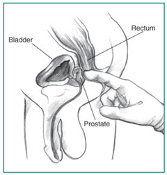 Cross-section of a digital rectal exam. A health care provider’s gloved index finger is inserted into the rectum to feel the size and shape of the prostate .