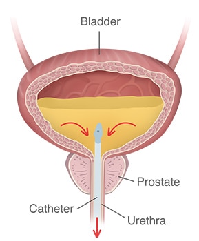 Postpartum Bladder Urinary Retention: Pregnancy's Effects on Bladder -  CompactCath