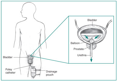 Outline of a male body showing the bladder, penis, drainage pouch strapped to one leg, and the inserted Foley catheter. Inset of the bladder, prostate , and urethra, showing urine flow from the bladder through the catheter.