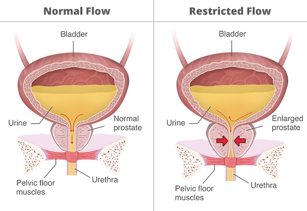Why Might You Struggle with Urinary Retention?