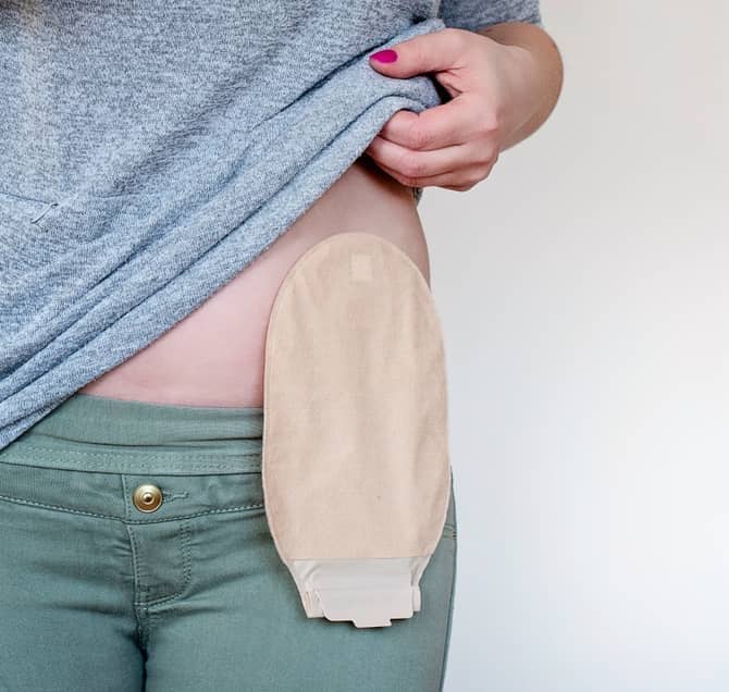 Amazon.com: Cathwear Catheter Leg Bag Underwear - Leg Bag Holder for Boys &  Girls - Catheter Supplies Compatible with Foley, Nephrostomy, Suprapubic &  Biliary Catheters Holds (2) 600ml Leg Bags - Black -