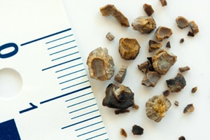 how to get rid of kidney stones