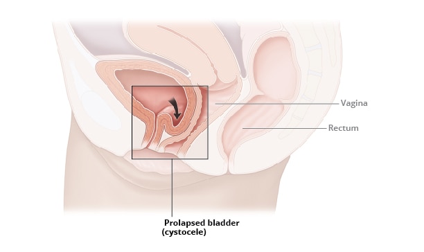 The prolapsed bladder was pushed back to the abdominal cavity through