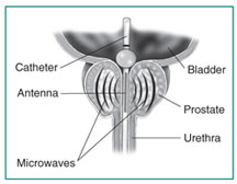 Cross-section of the prostate , bladder, and urethra. A transurethral microwave thermotherapy catheter extends from the urethra into the bladder. An antenna sends microwaves through the catheter to the prostate .