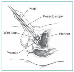 Cross-section of the penis, prostate , and bladder. A resectoscope is inserted through the urethra to the prostate . A wire loop at the end of the resectoscope cuts tissue from the prostate .