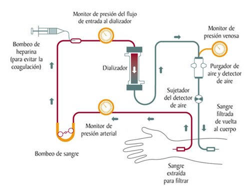 Resultado de imagen de hemodialisis explicacion