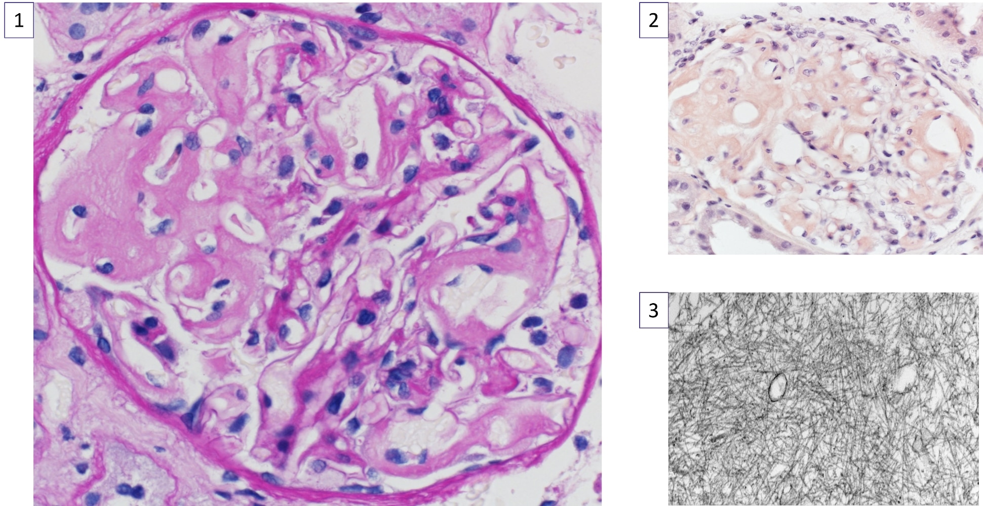 A collage of slides of a kidney biopsy. Image 1 shows a single glomerulus from a kidney biopsy. Within the glomerulus, there are deposits that appear acellular and are negative for periodic acid-Schiff (PAS) staining. These deposits are highlighted by a black arrow in the image. The PAS stain typically helps identify certain cellular components and structures, but in this case, the deposits do not react with the stain, indicating their unique composition. Image 2 shows a single glomerulus from a kidney biopsy. The glomerulus is a cluster of tiny blood vessels, and in this picture, there are distinctive features of these structures. The main focus is on the presence of congophilic deposits, which are light orange in color. These deposits are located in two key areas: the mesangium (the central region of the glomerulus where the blood vessels are connected) and the capillary walls (the thin, tube-like structures that make up the blood vessel network). The capillary loops, which are the parts of the glomerulus where blood filtration occurs, are notably wide open in this image. Image 3 shows a high magnification transmission electron microscopy (TEM) view, showing amyloid deposits at a magnification of 50,000 times. The image is in black and white, revealing randomly oriented fibrils, which are long, thin, and thread-like structures. These fibrils appear scattered without a distinct pattern or alignment, typical of amyloid deposits. The high magnification allows for detailed observation of the fibrils' structure and arrangement.