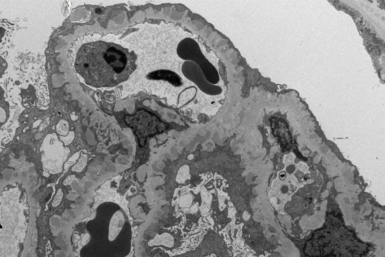 Dark projections representing immune deposits that form on top of the glomerular basement membrane in the kidney disease membranous nephropathy.