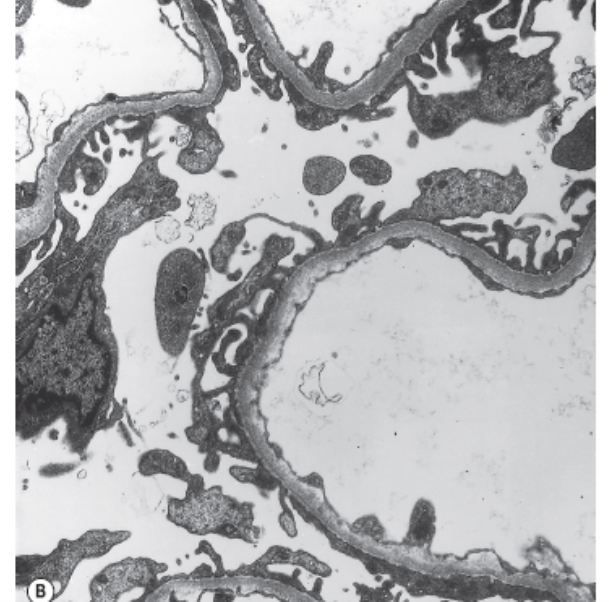 Ultrastructure of a normal glomerular capillary wall.