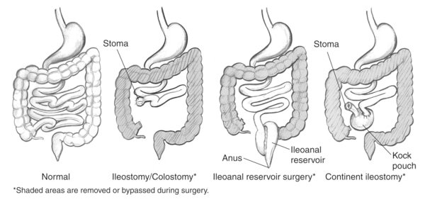 Normal Bowel And Three Types Of Bowel Diversion Surgeries Including Ileostomy Colostomy