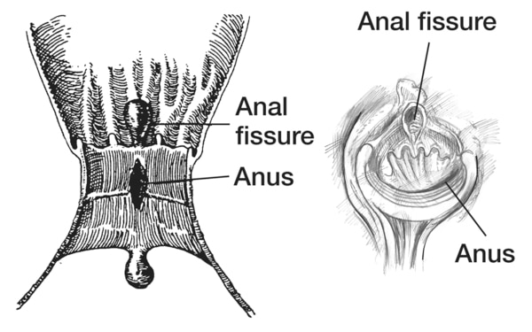 Cross Section And A Direct View Of The Anus With A Fissure Media 2650