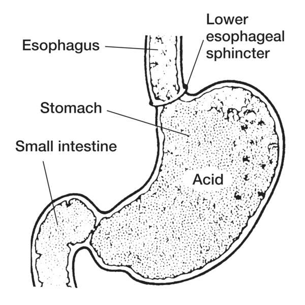 esophageal sphincter