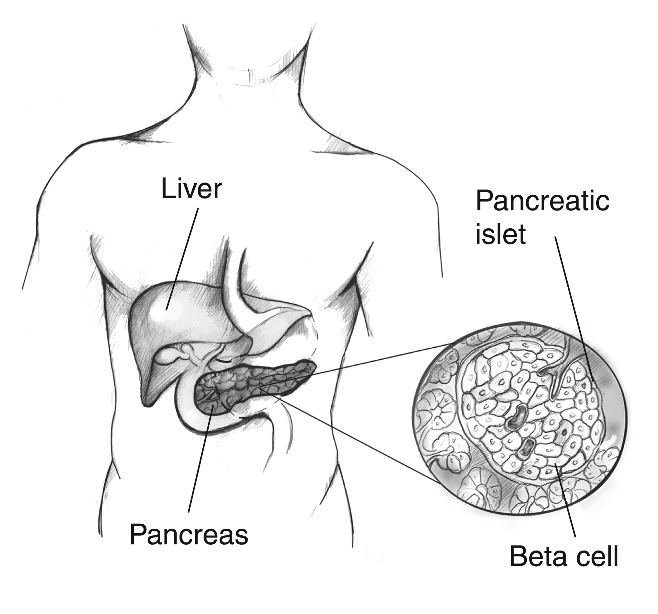 pancreas diabetes diagram