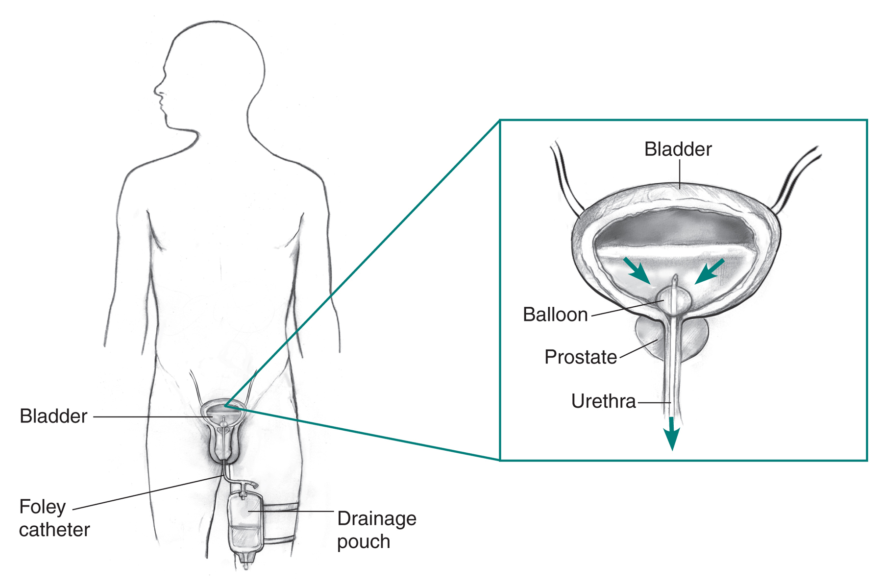 male urinary catheter