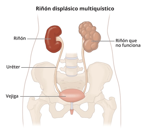 Multicystic dysplastic kidney with labeled nonworking kidney, kidney, ureter and bladder.