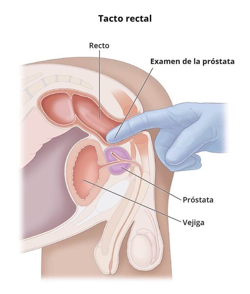 Diagrama de la sección transversal de un tacto rectal con etiquetas que identifican el recto, la próstata y la vejiga.