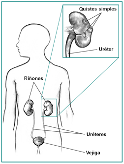 Conducto urinario de una figura masculina, con un recuadro que muestra unos quistes renales simples